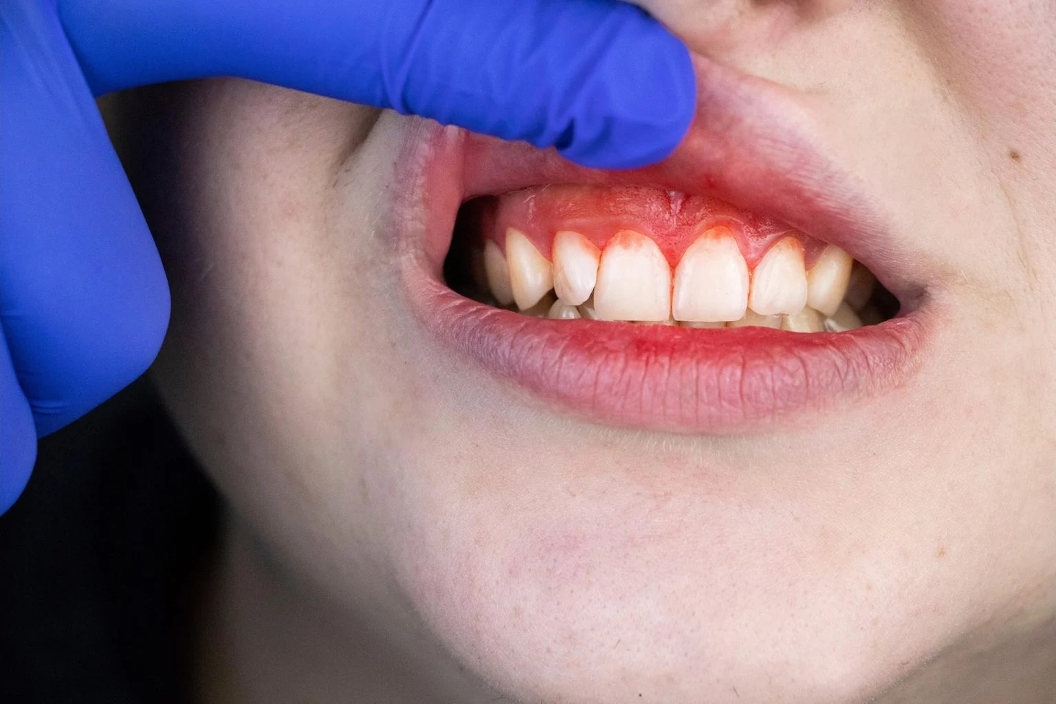 10 Causes of Bleeding Gums