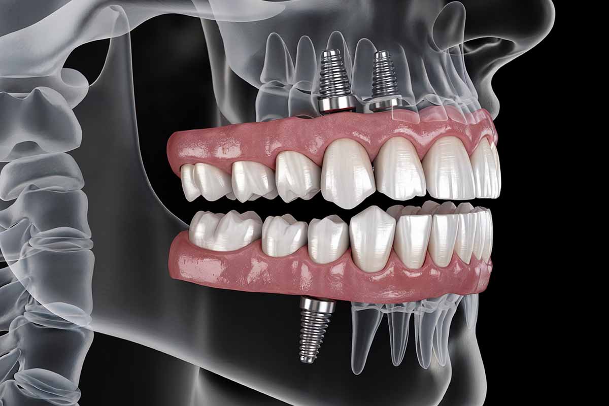 What Is Bone Grafting in Dental Implants?