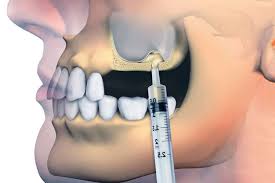 Sinus Lift Cost in Turkey 2026
