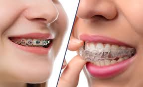 Invisalign vs Braces: Which One Is Right for You?