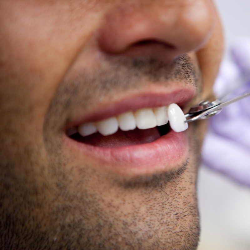 Laminate Veneers